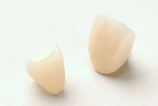 セラミックによる審美歯科治療