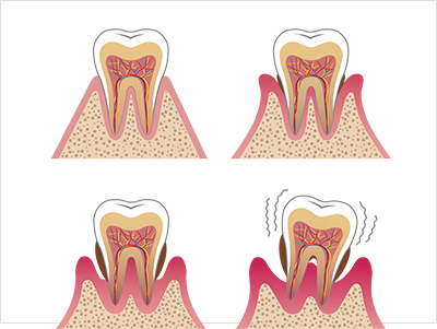 歯周病の症状